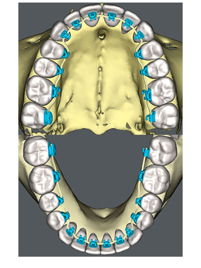 lingual braces