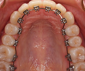 lingual braces